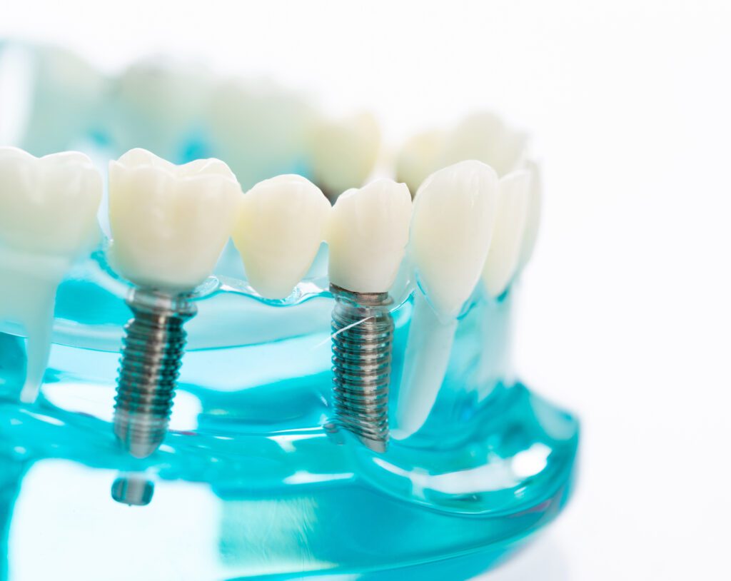 Benefits of Dental Implants in San Antonio, TX