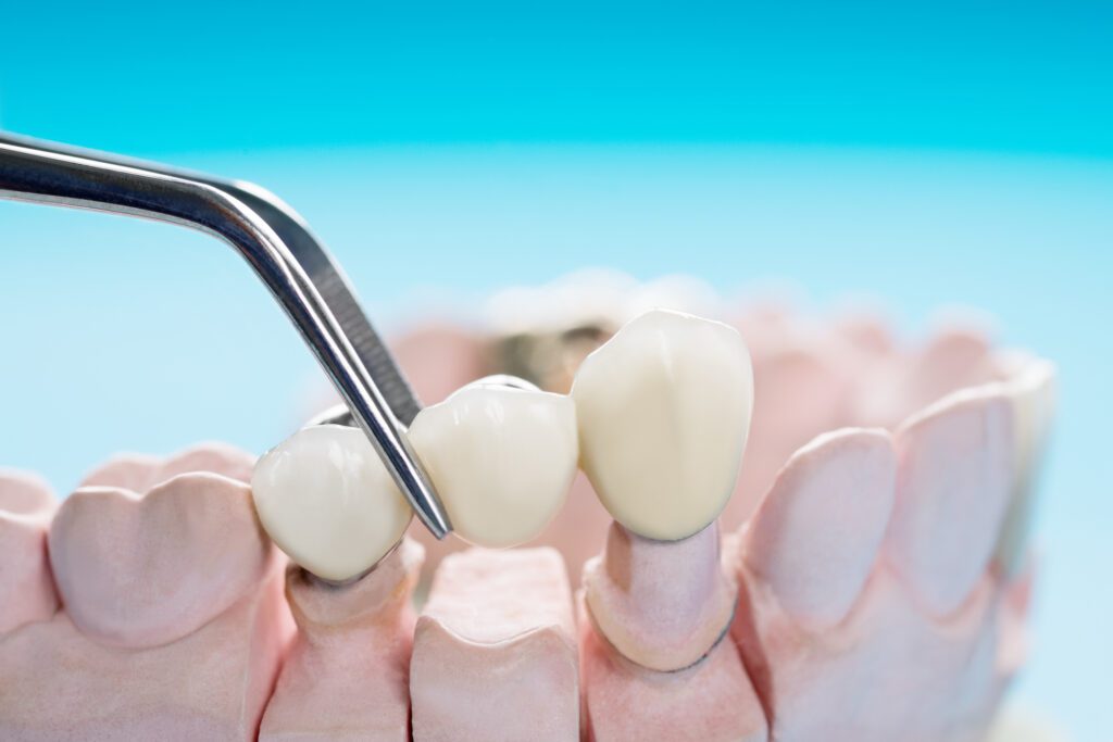 Multiple Teeth Implants in San Antonio, TX