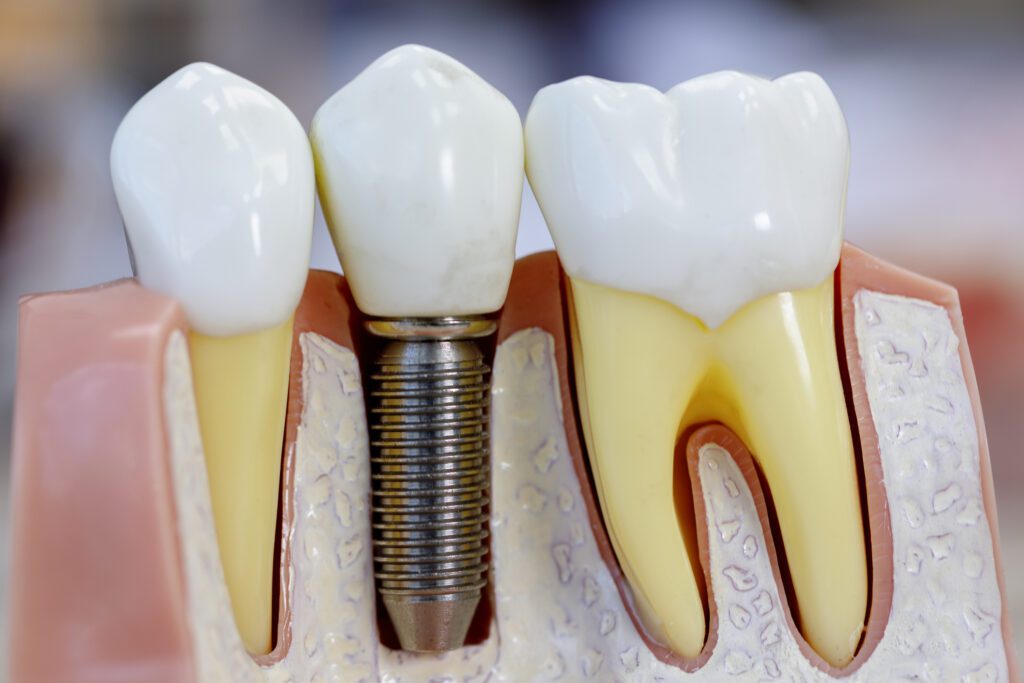 Single Tooth Implants in San Antonio, TX