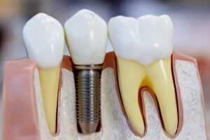 Dental Implants in San Antonio, TX