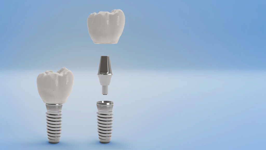 Implant Procedure in San Antonio, TX