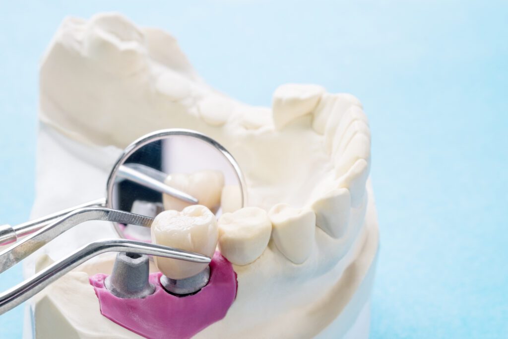 What Are Dental Implants in San Antonio, TX