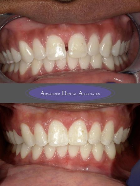 before dentistry at Advanced Dental Associates