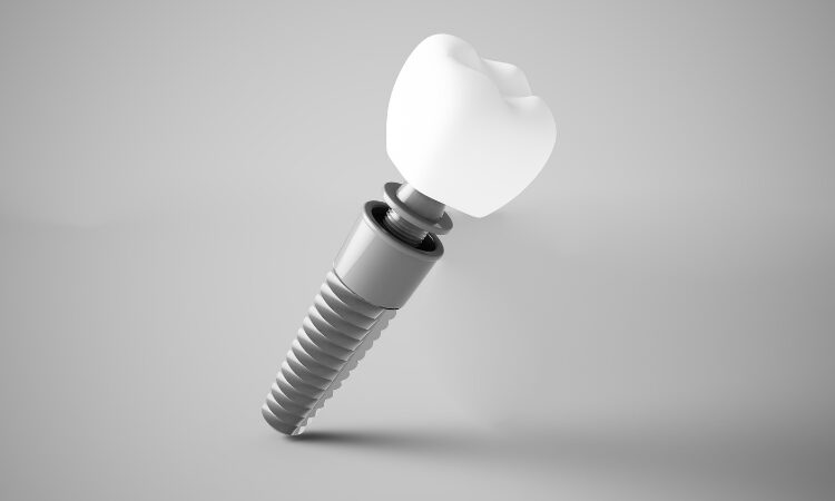 Long-term Benefits of Dental Implants