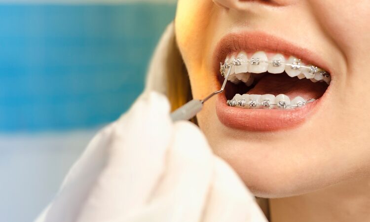 Understanding when traditional braces may be the best option is crucial for making an informed decision about your oral health.