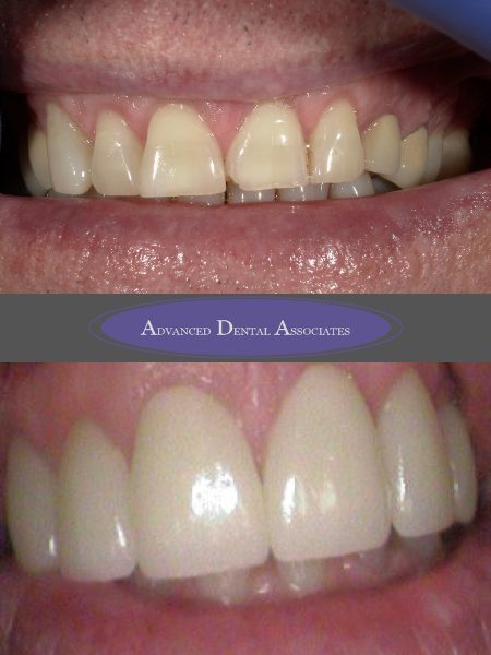 Crown Lengthening & Porcelain Veneers